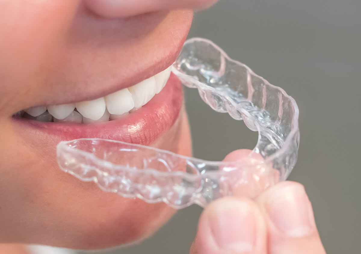 SureSmile Clear Aligners in Frederick Maryland Area