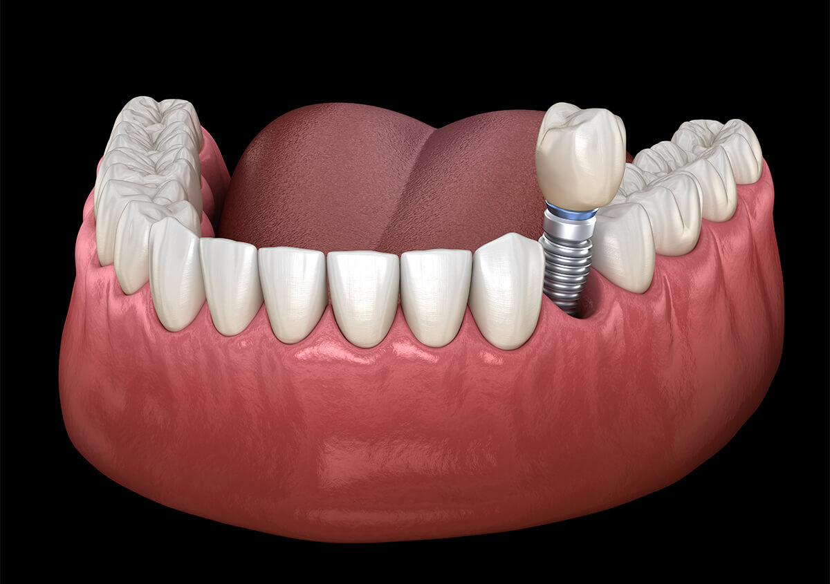 Advantages of Dental Implants in Frederick MD Area
