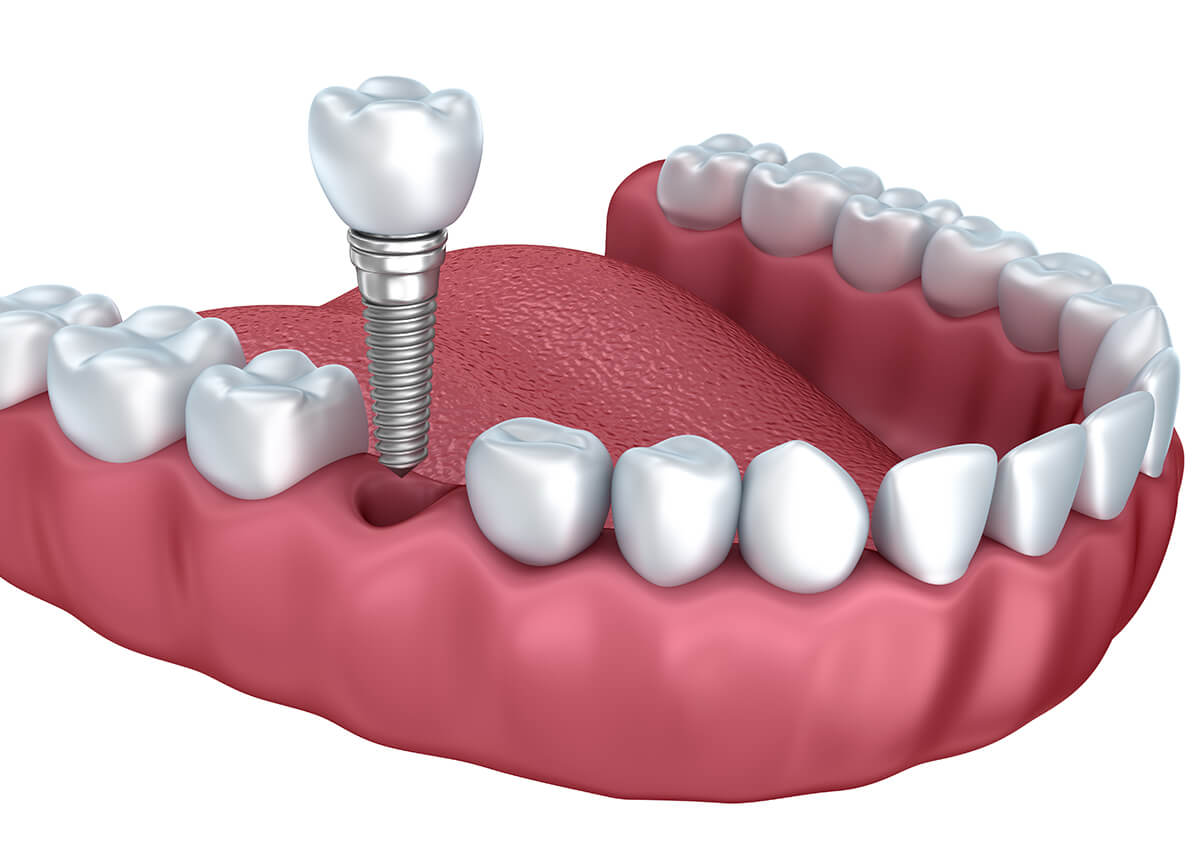Dental Implants FAQs in Frederick MD Area